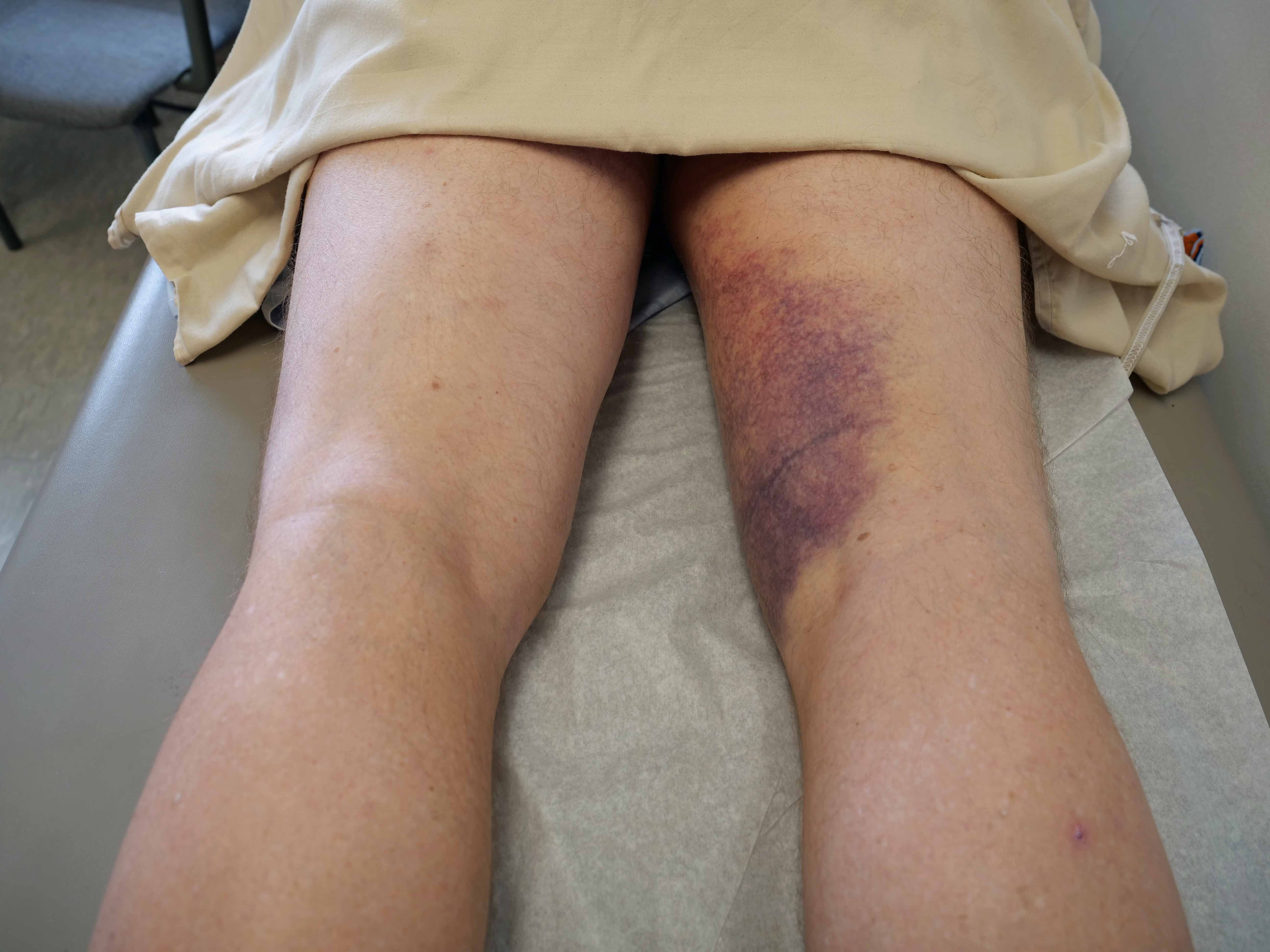 Bruising from torn hamstring