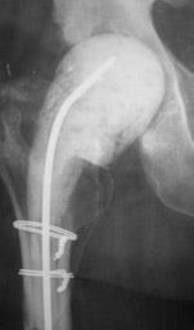 Joint Replacement Infection - OrthoInfo - AAOS