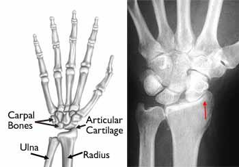 Wrist osteoarthritis