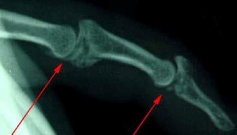 X-ray of fractures within the finger joints
