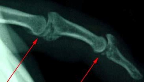 Arthritis: An Overview - OrthoInfo - AAOS