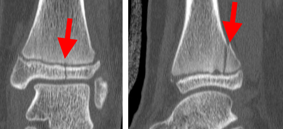 Ankle Fractures In Children - OrthoInfo - AAOS