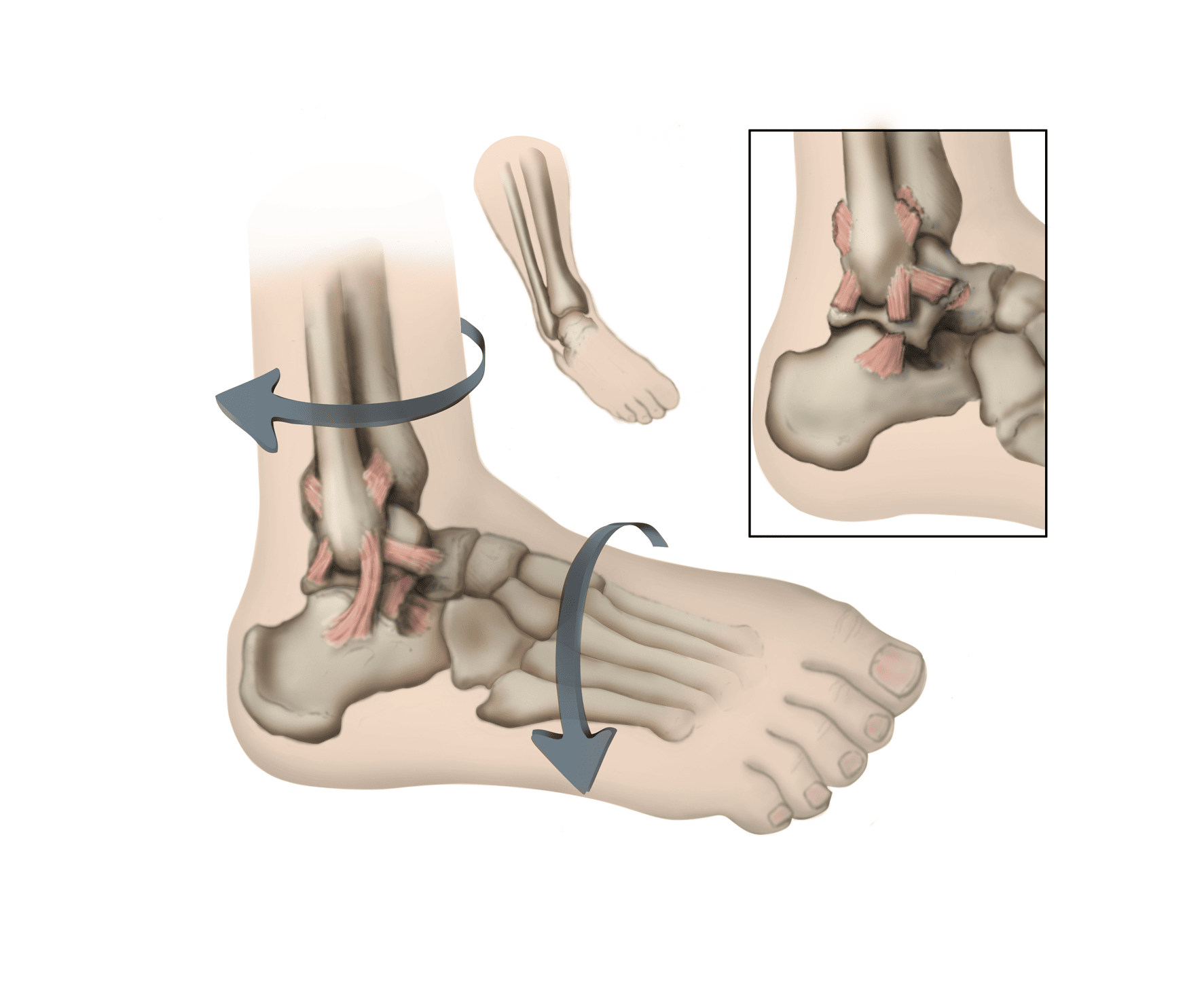 Outside Ankle Pain (Lateral) - Symptoms, Causes & Treatment & Rehab