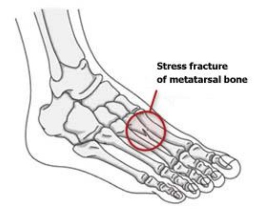 stress fracture