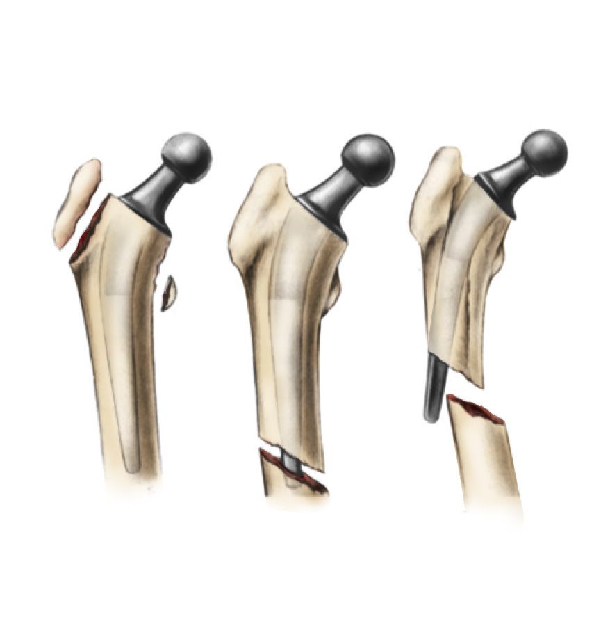 Periprosthetic Fracture After Total Hip Replacement Dr Mukhis Raj