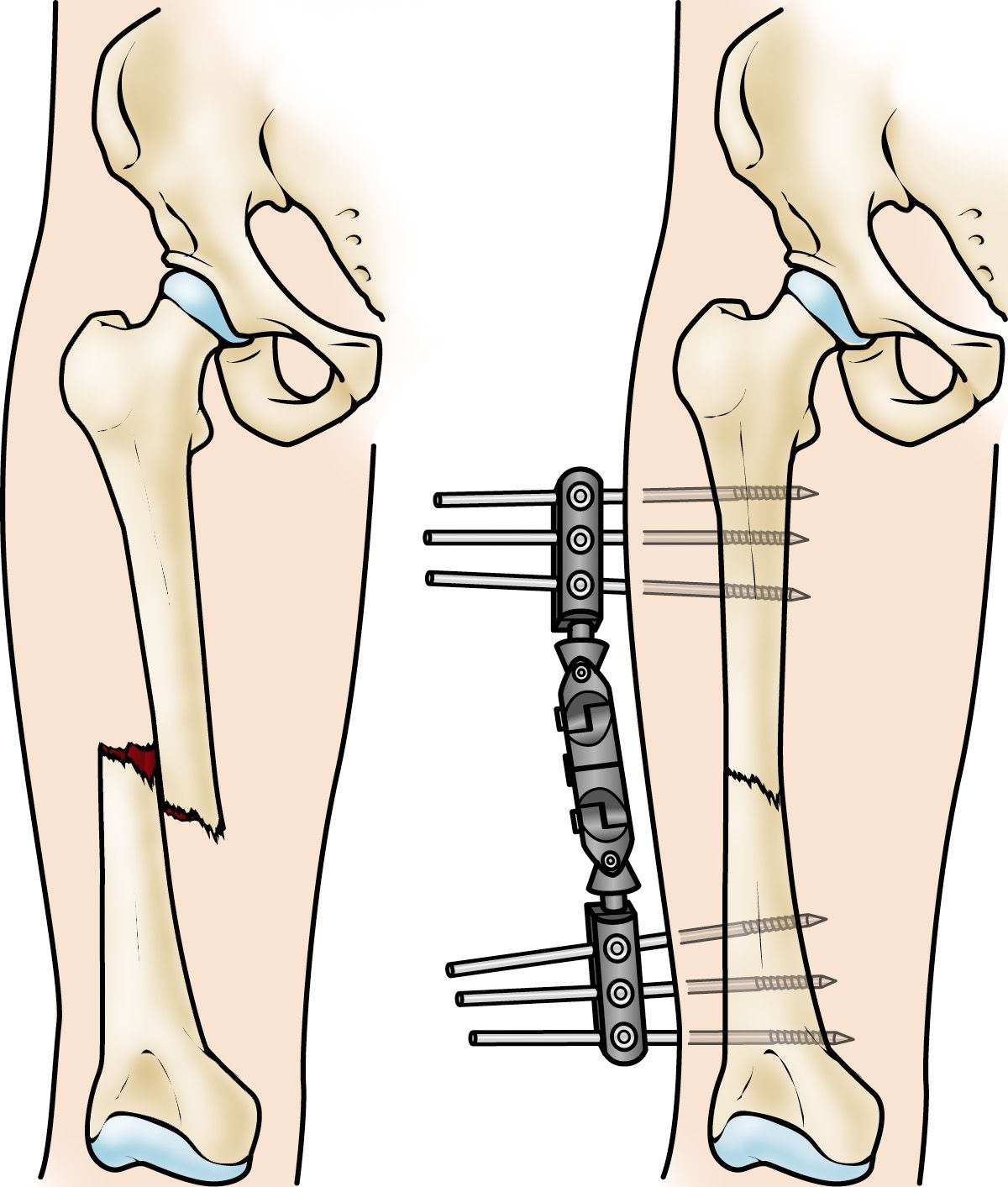 External fixator