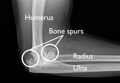 radiografía de la osteoartritis del codo