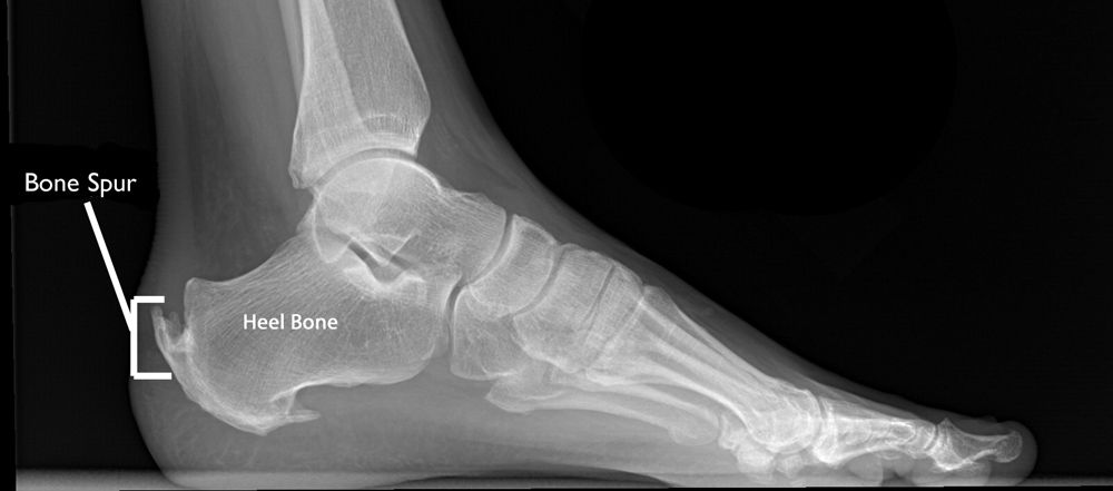 Bone spur deals near achilles tendon