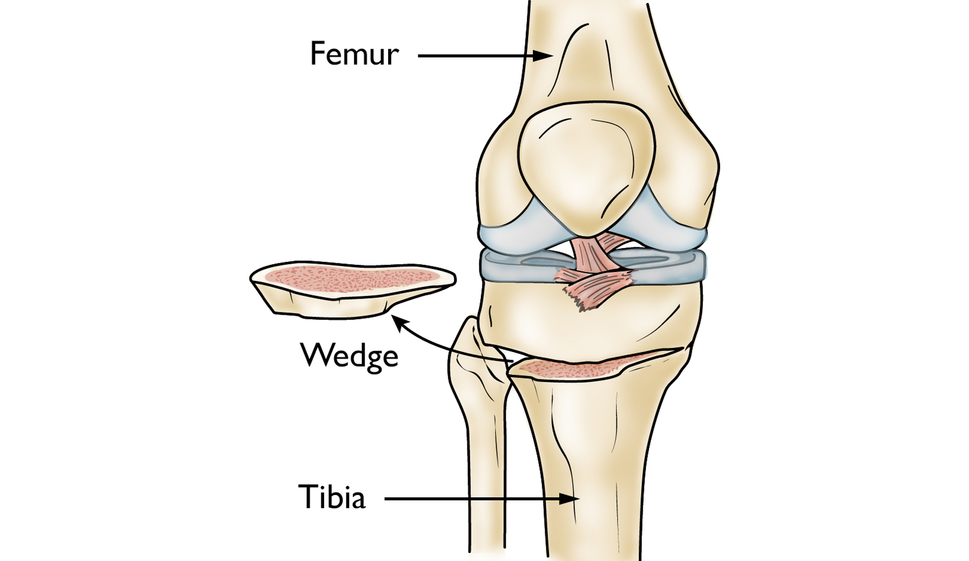 knee osteotomy illustration