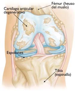 Artrosis rodilla