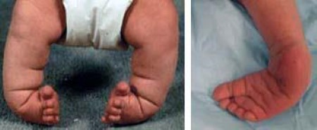 Clubfoot Orthoinfo os