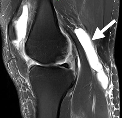 MRI of a Baker's cyst