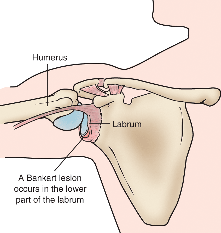 Chronic Shoulder Instability and Dislocation - OrthoInfo - AAOS