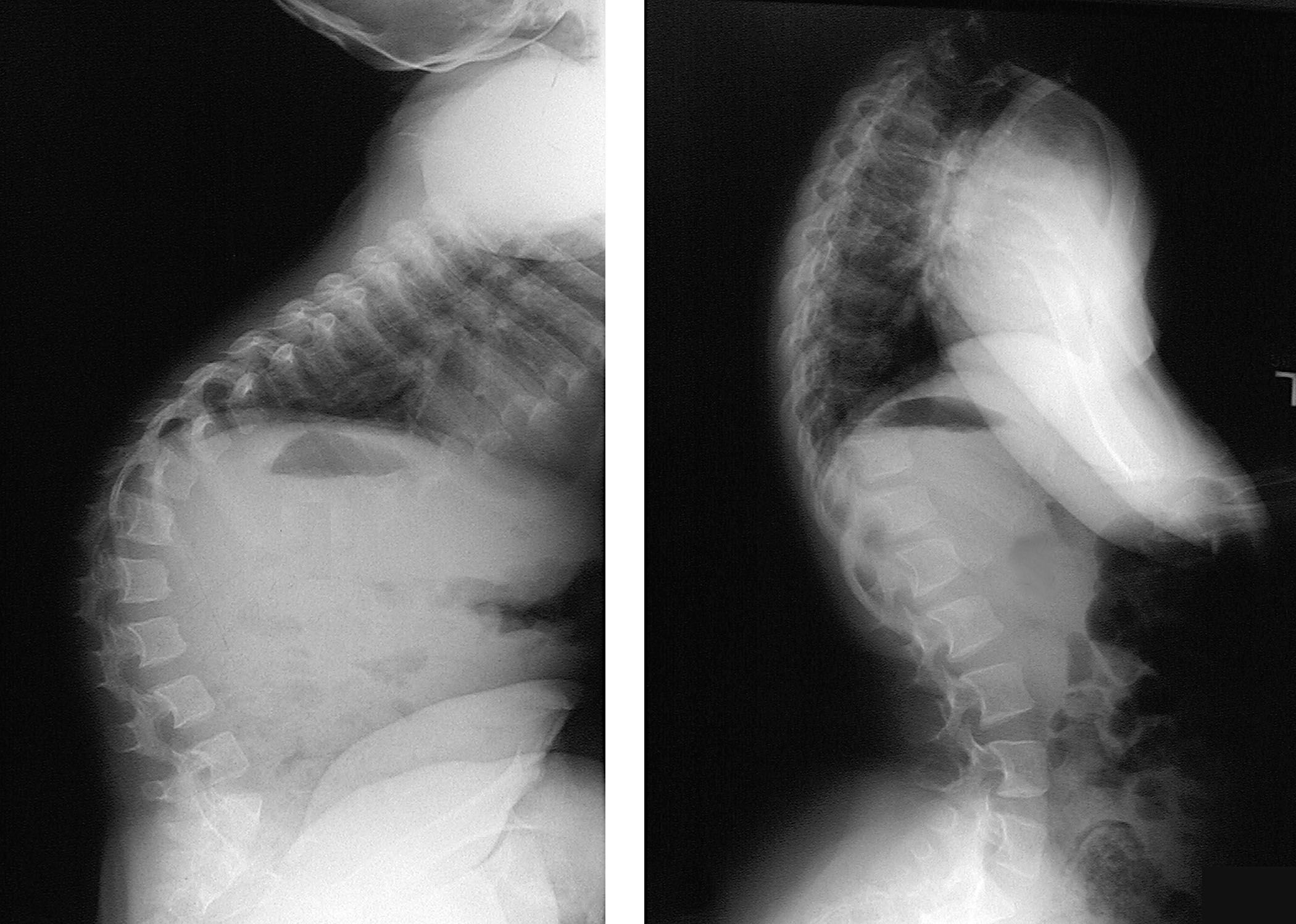 X-ray of kyphosis