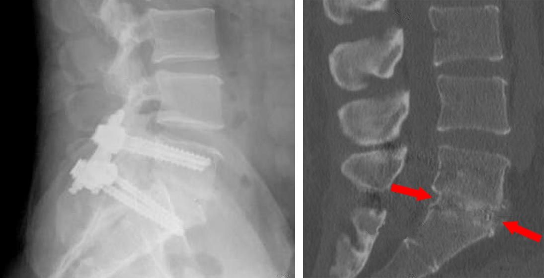 X-ray of TLIF procedure and CT scan of fusion