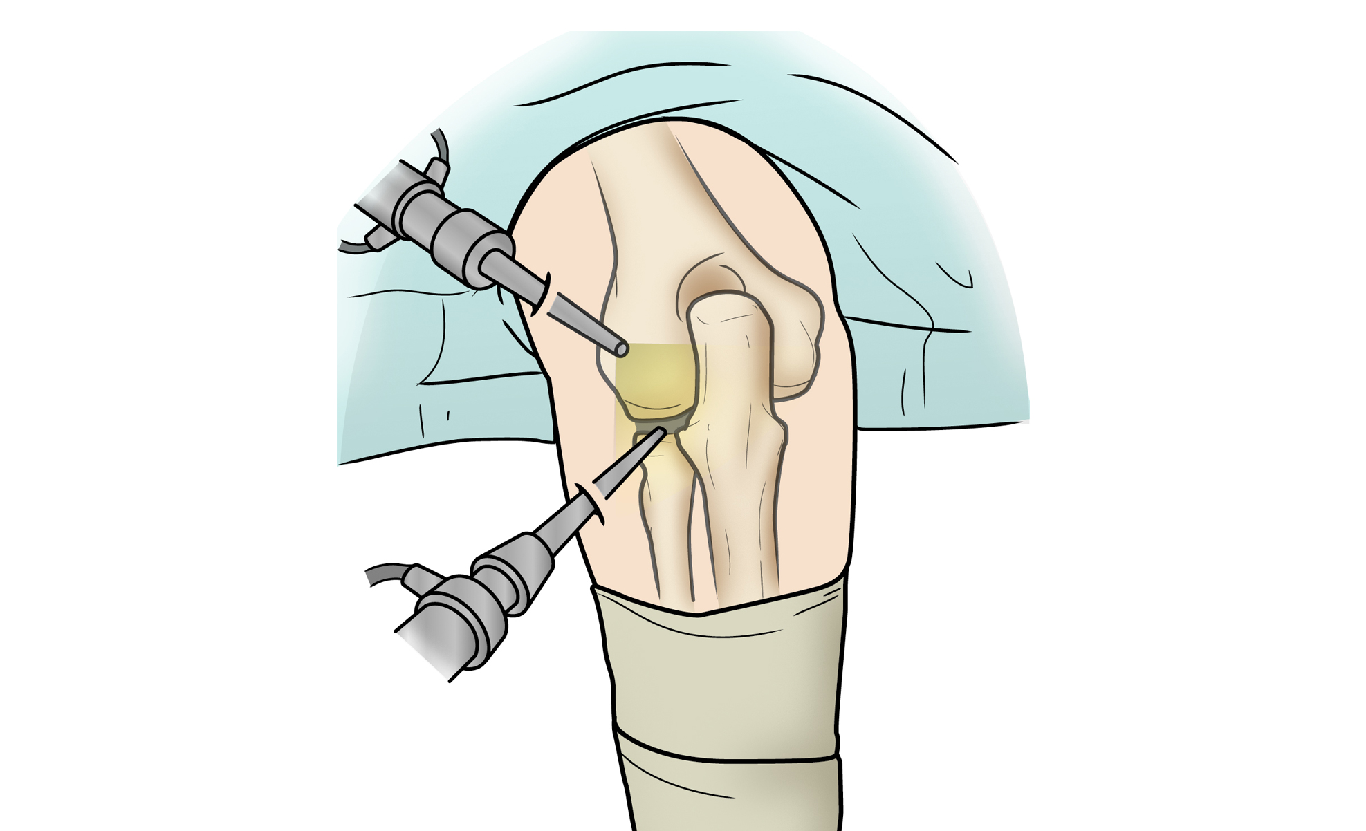 Osteoartritis de rodilla (Knee Osteoarthritis) - OrthoInfo - AAOS