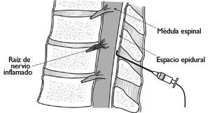 Espondilosis cervical (osteoartritis de cuello) (Cervical ...