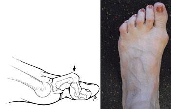 Hammer toe