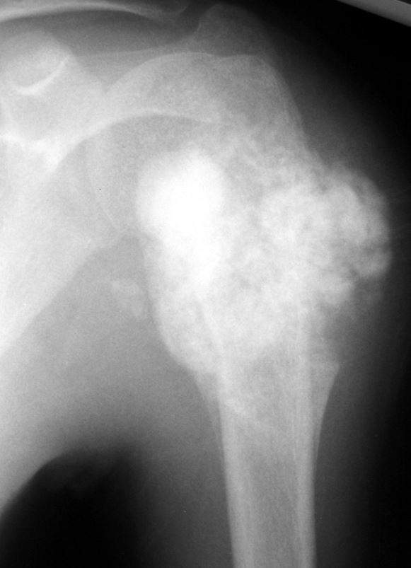 Radiografía de osteosarcoma en el hueso del brazo superior