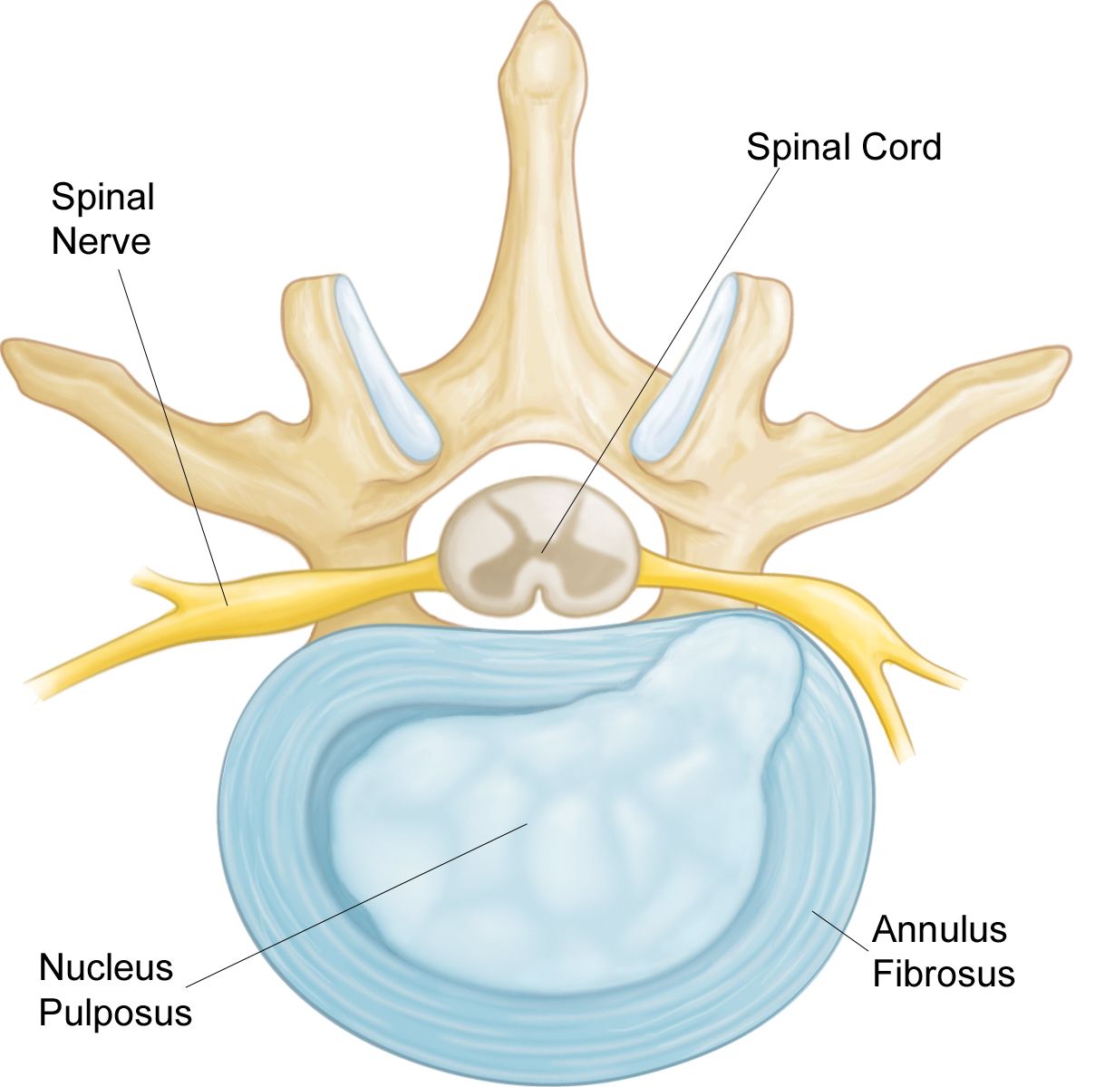 Illustration of a herniated disk