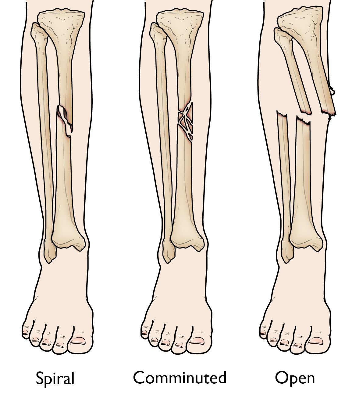 Spiral, comminuted, and open tibial shaft fractures