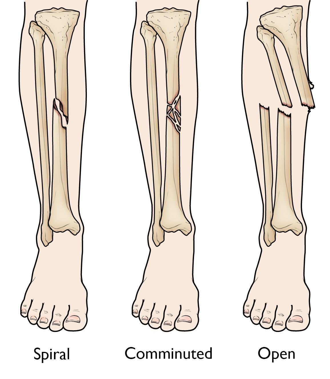 Broken Leg: If my tibial shaft fracture gets surgery, when can I