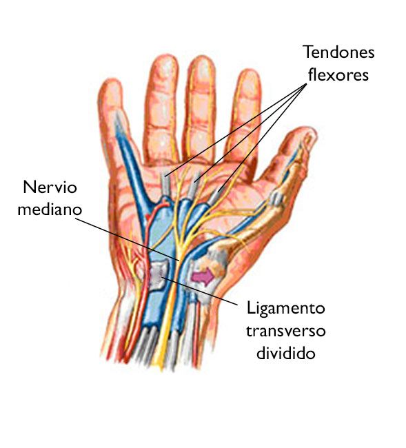 tendones flexores de la muñeca