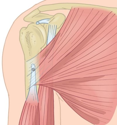 Tenodesis del bíceps
