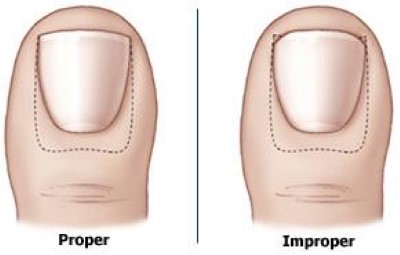 Ingrown Toenail - OrthoInfo - AAOS