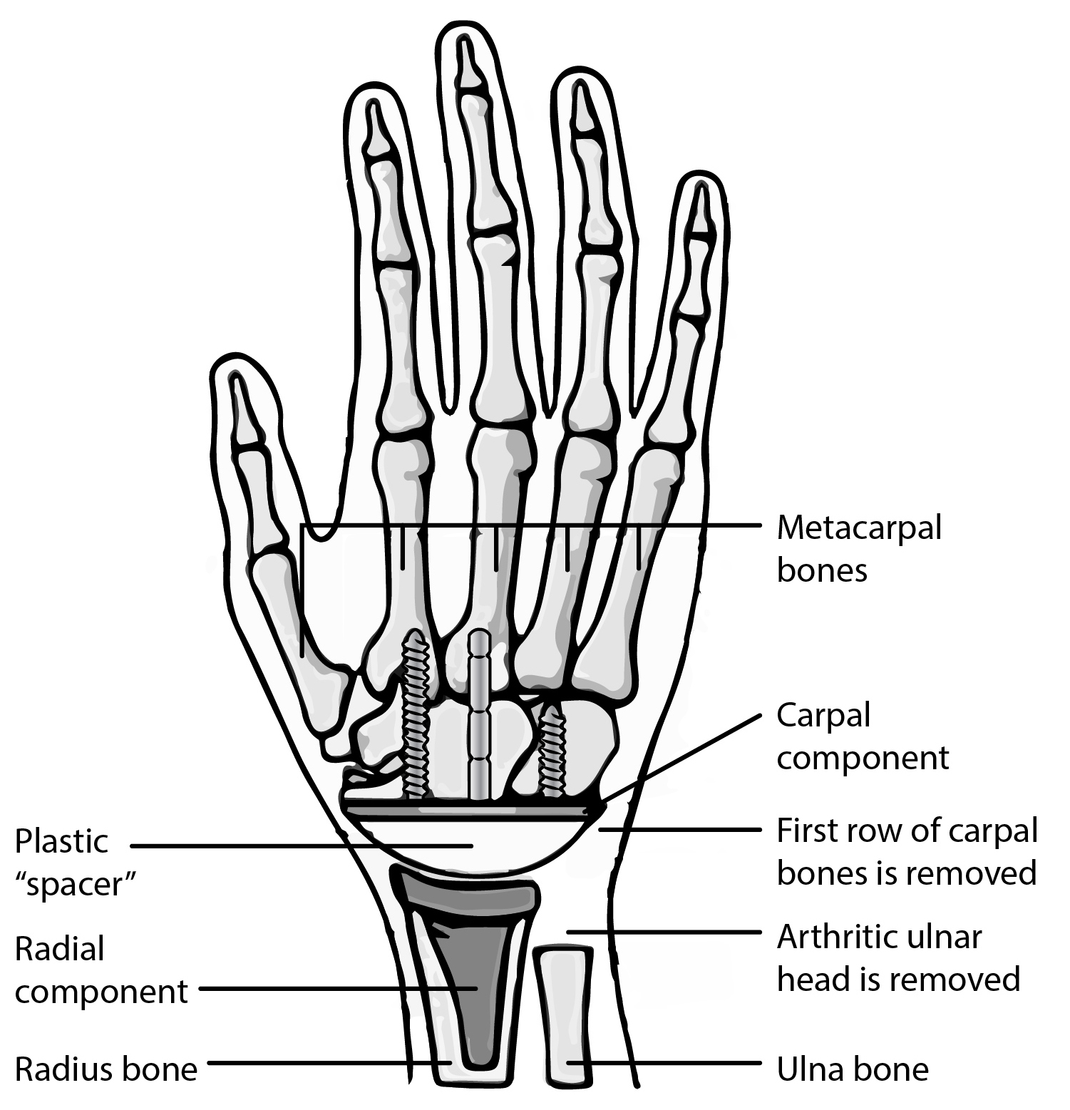 Components of a wrist arthroplasty