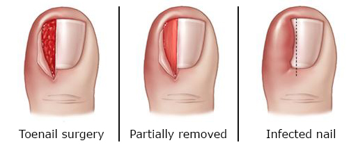 Treatment of ingrown toenail