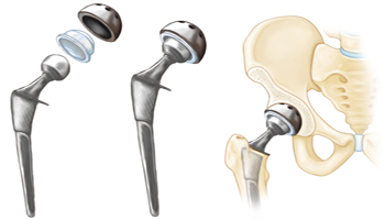 hip replacement implants