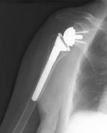 Reverse total shoulder replacement