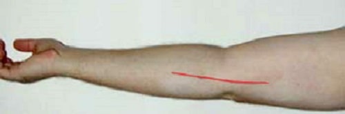 Location of incision for anterior transposition of ulnar nerve