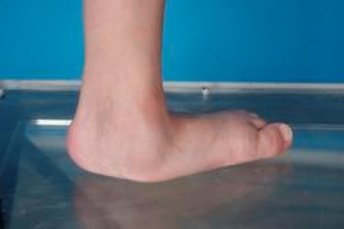 Congenital vertical talus, left foot, in a 5-year-old girl, before