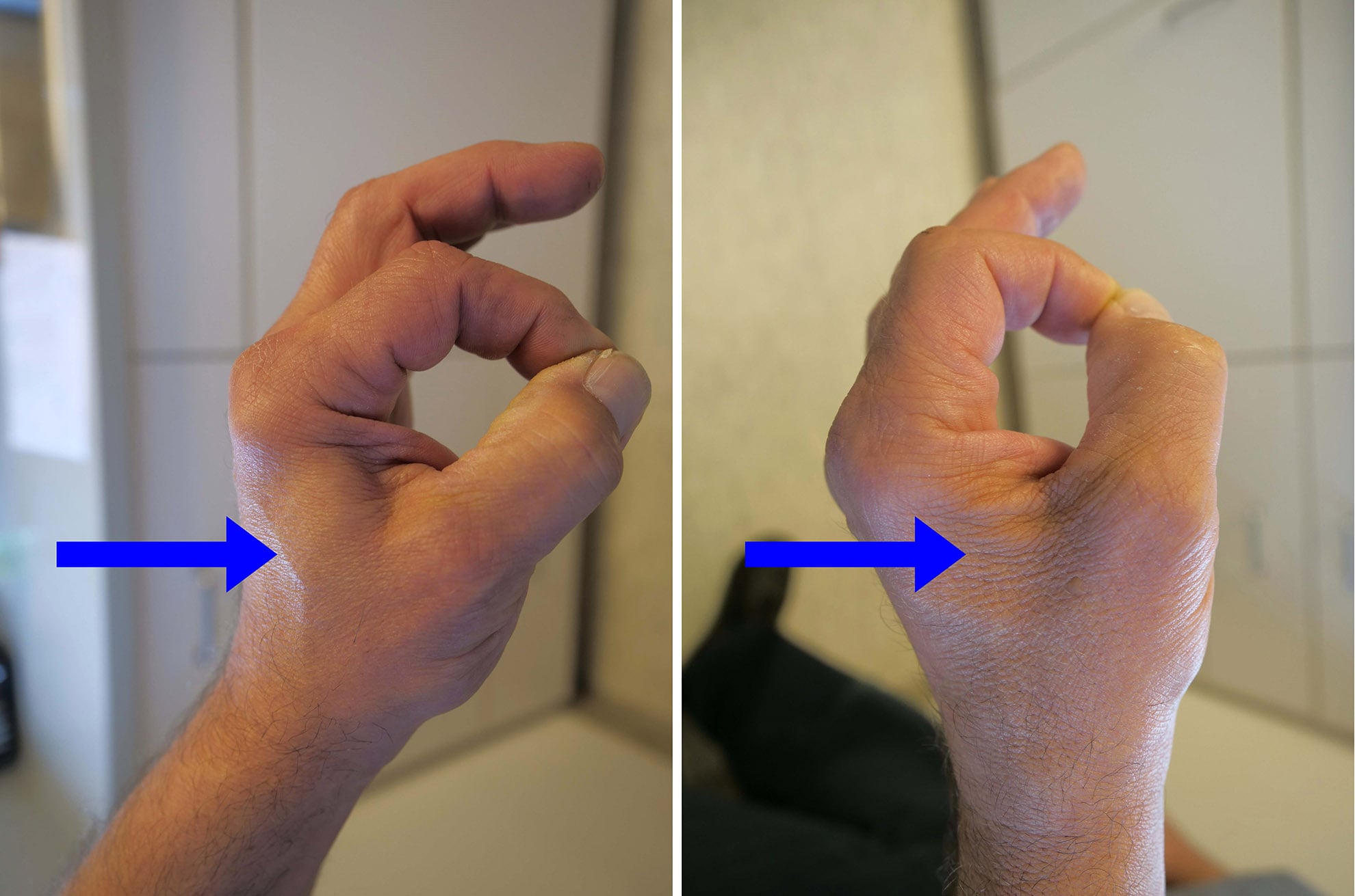 ulnar-nerve-entrapment-at-the-elbow-cubital-tunnel-syndrome