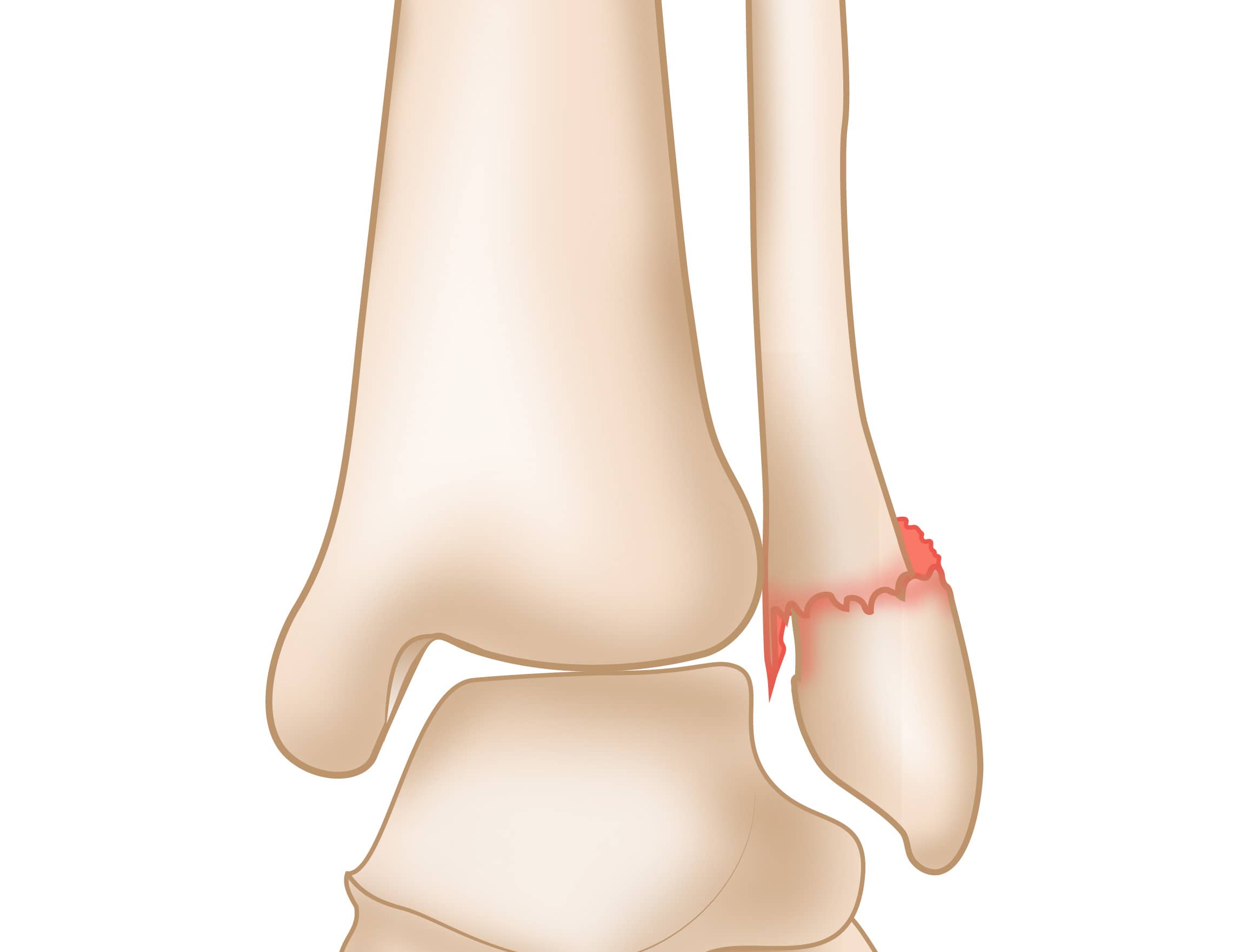 Ankle Fractures Broken Ankle OrthoInfo AAOS