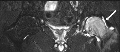 Transient Osteoporosis of the Hip - OrthoInfo - AAOS