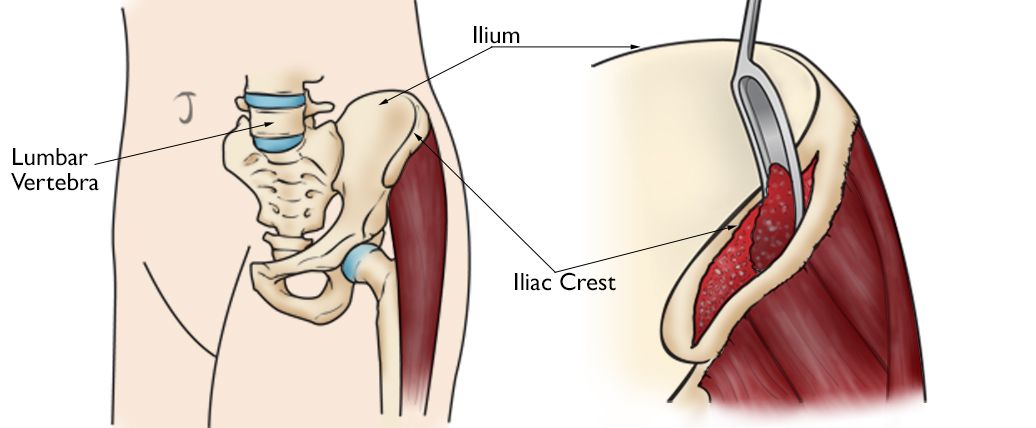Pelvis anatomy, including iliac crest