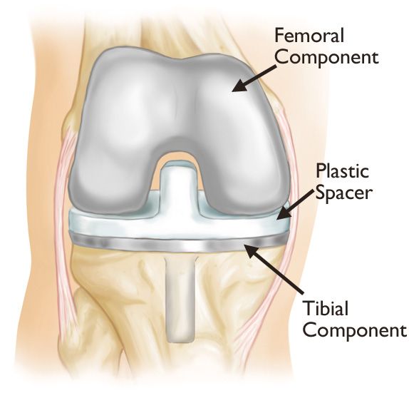 Minimally Invasive Total Knee Replacement - OrthoInfo - AAOS