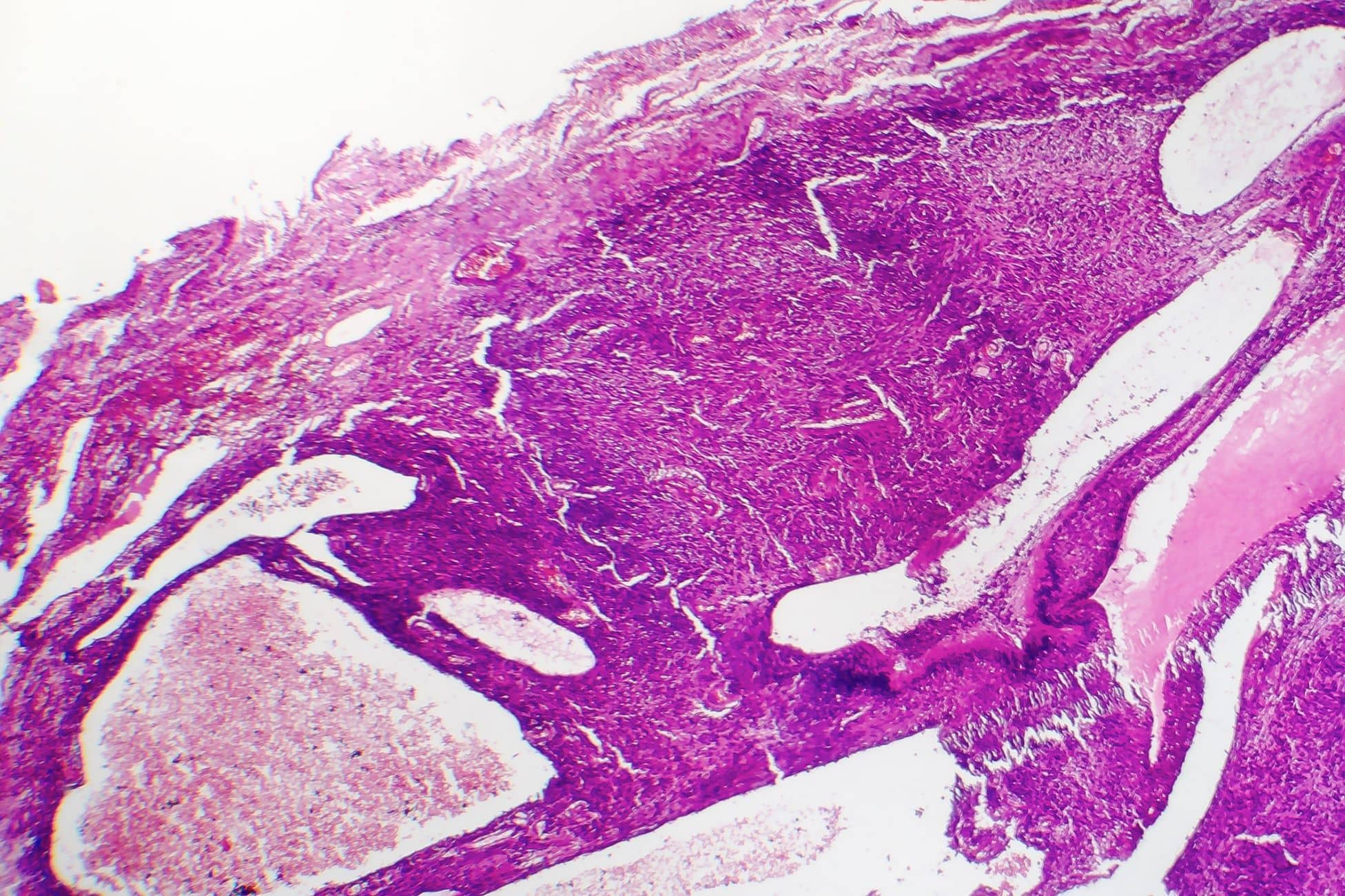 Osteoartritis de rodilla (Knee Osteoarthritis) - OrthoInfo - AAOS