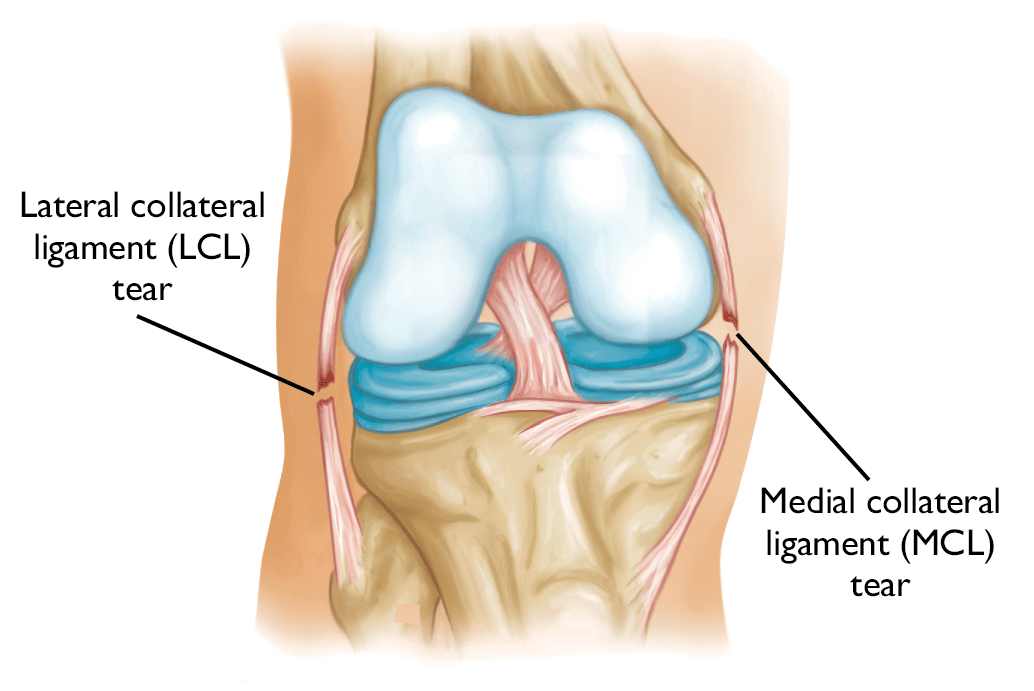 collateral ligament tears