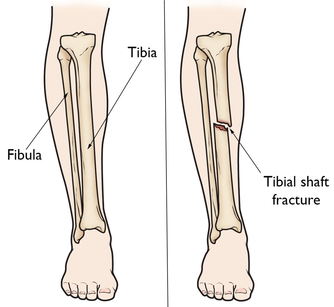 fractured fibula