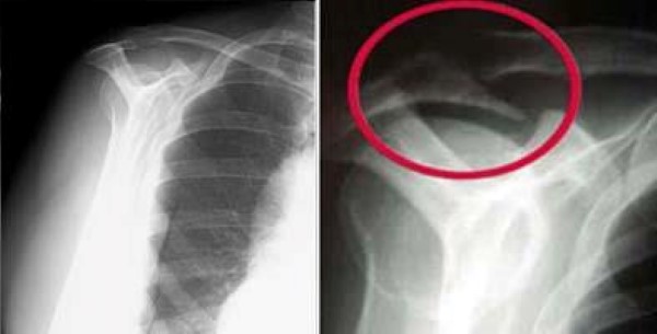 Vistas de salida de rayos X del hombro de normal y espolón óseo.