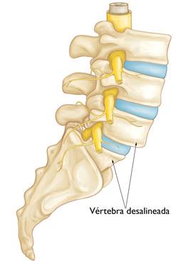 Dolor lumbar: Qué es, síntomas, causas y cómo lo tratamos