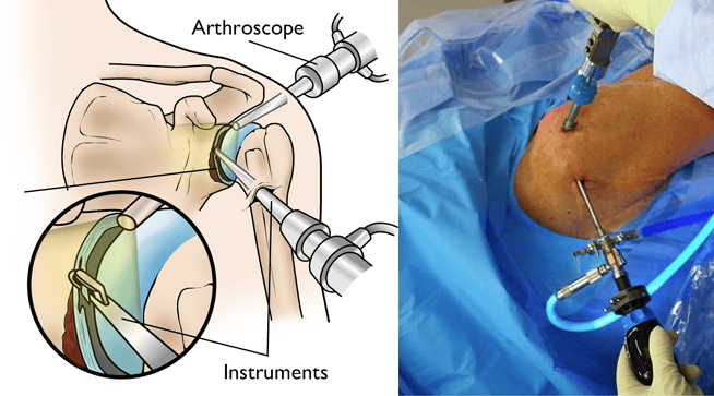 shoulder arthroscopy