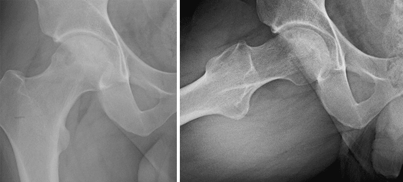 X-rays from two angles showing osteonecrosis of the hip