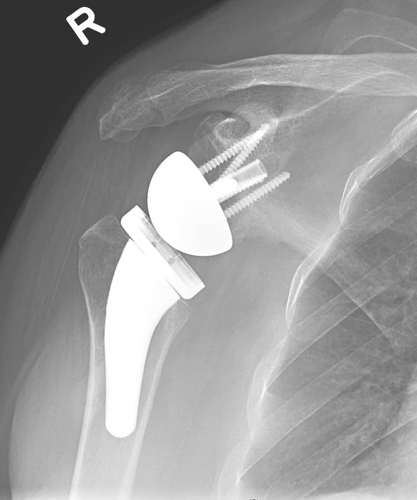 Reverse total shoulder replacement