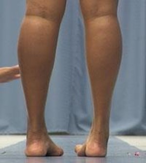 calf and ankle muscle atrophy