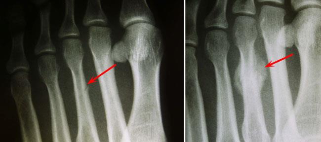 Toe and Forefoot Fractures - OrthoInfo - AAOS